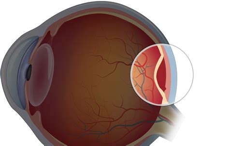 Retinal Tear Vs Retinal Detachment Retina Associates Kansas City