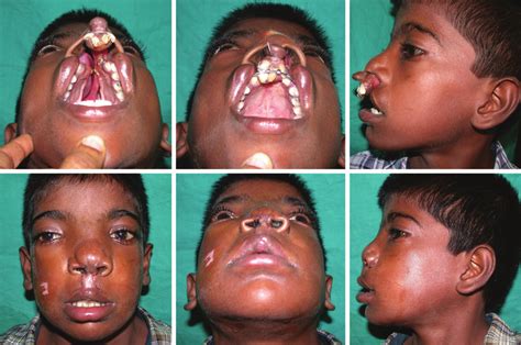 An 11 Year Old Boy With Complete Bilateral Cleft Of The Lip And Palate