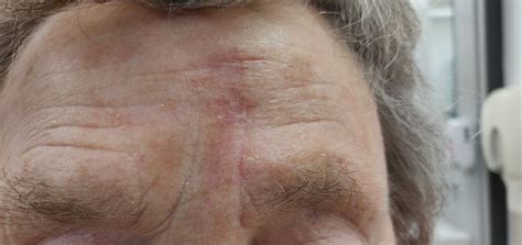 Basal Cell Cancer On The Forehead Dr Vindy Ghura Dermatologist Manchester