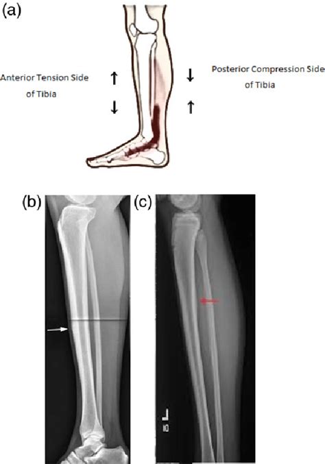 Proximal Tibia Stress Fracture