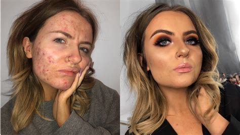 Acne Face Before And After Makeup Saubhaya Makeup
