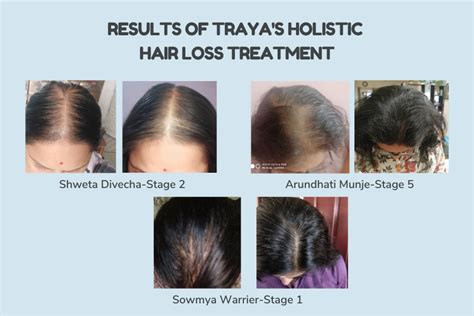 A Case Study Of Female Pattern Hair Loss Improved In Women By Trayas