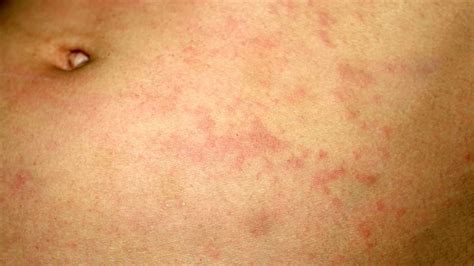 Pityriasis What Is Pityriasis Rosea Symptoms And Treatment