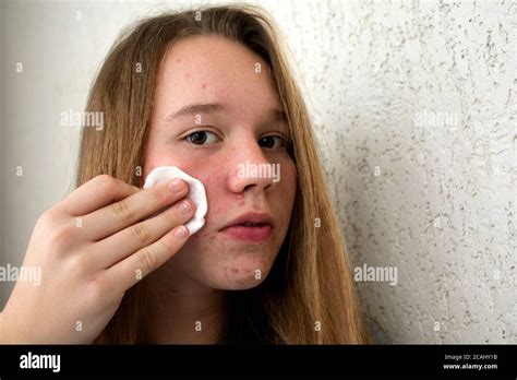 A Teenage Girl Has Acne On Her Face Problem Skin Acne On The Face Of