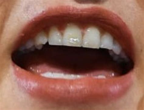 Becky Lynch S Teeth Pictures