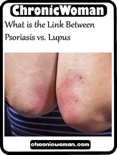 What Is The Link Between Psoriasis Vs Lupus Lupus