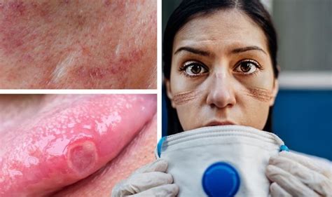 Coronavirus Uk Update Symptoms Include Skin Rashes And Covid Tongues