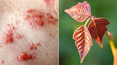 What Does Poison Ivy Look Like Everyday Health