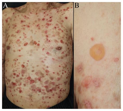 Bullous Pemphigoid Associated With Use Of Dipeptidyl Peptidase 4