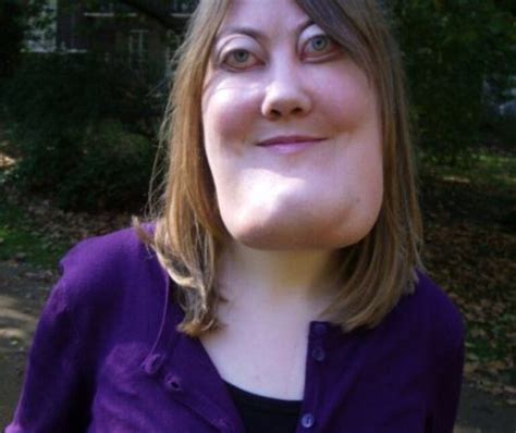 She Was Diagnosed With Cherubism At The Age Of 4 A Rare Facial Disfigurement Developed In Her