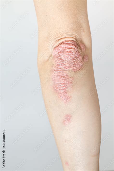 Acute Psoriasis On Elbows Is An Autoimmune Incurable Dermatological Skin Disease Large Red