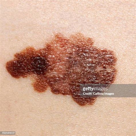 Squamous Cell Carcinoma Photos And Premium High Res Pictures Getty Images