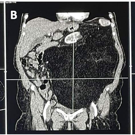 A B C Abdominal Contrast Enhanced Computed Tomography Cect Showing