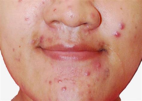 Pimples Face Acne Skin Disease For Young People