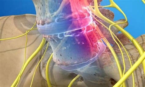 Spondylolisthesis Causes Symptoms And Treatments