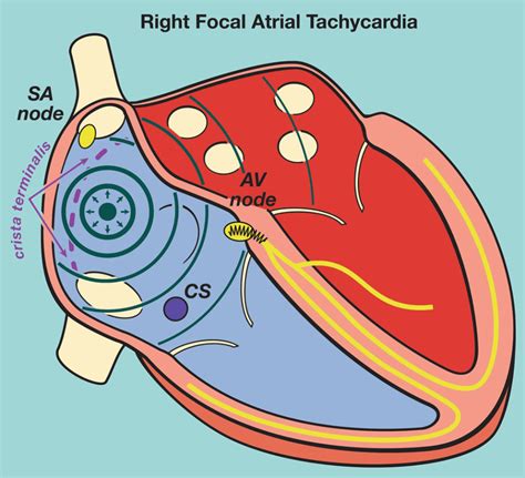 Surgery And Epicardial Pacemaker Strategies Thoracic Key