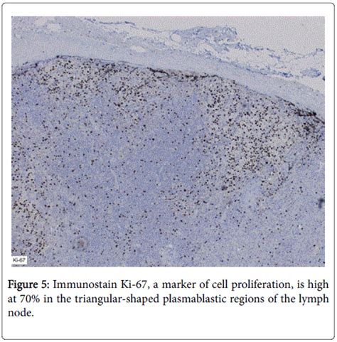 Ebv Positive Plasmablastic Lymphoma Mimicking Reactive Lymphadeno