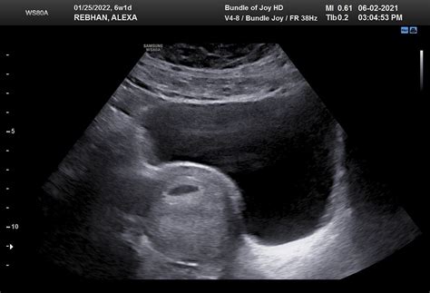 6 Week 1 Day Abdominal Ultrasound Babycenter