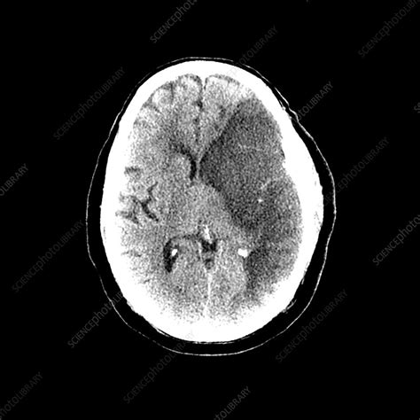 Ct Scan Stock Image M1360248 Science Photo Library