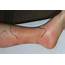 Summertime Sighting Painful Swelling Erythema Around The Ankle