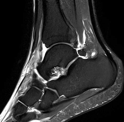 Foot And Ankle Mri Course Msk Radiology Mini Fellowship Mri Online