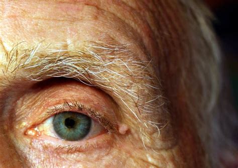 Some Of The Common Eye Diseases In Elderly People
