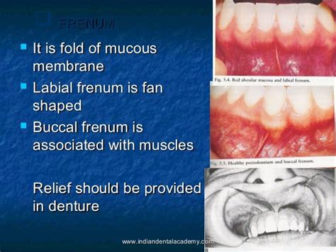 Oral Mucous Membrane Dental Crown And Bridge Courses