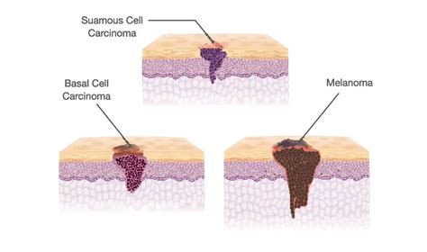 Skin Cancer Types Melanoma Basal And Squamous Cell Carcinoma Oncobeta