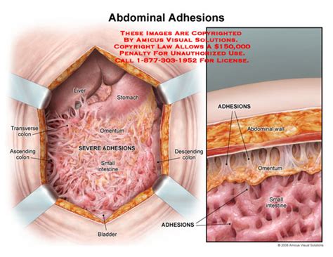 Amicus Illustration Of Amicus Injury Medical Scar Tissue Adhesions Abdominal Omentum Bowel