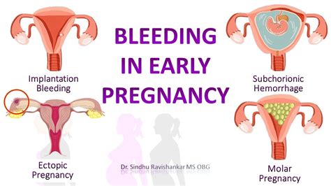 Is It Normal To Have Light Bleeding In Early Pregnancy