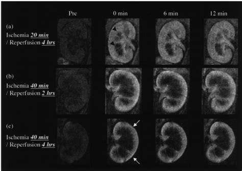 The Micro Mri Of Right Kidney Center With Acute Download