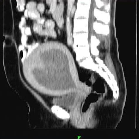 Ct Scan Reveals An Enlarged Uterus With Thickened Walls And Hematometra