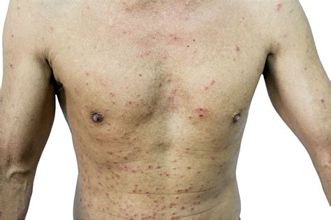 Life Threatening Skin Disease Captions Hd