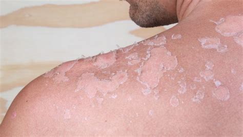 Simple Ways To Spot Skin Cancer Cancer Sharecare