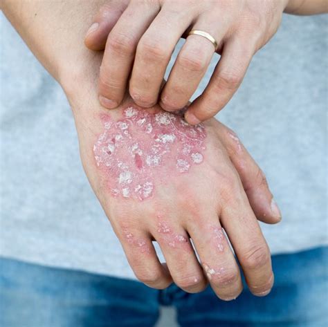 Psoriasis Pictures And Symptoms 5 Types Of Psoriasis To Know