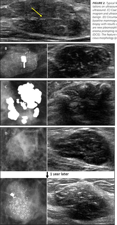 Figure 2 From Fibroadenoma From Imaging Evaluation To Treatment