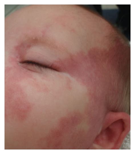 Capillary Malformation Port Wine Stain Of The Left Face In Infant