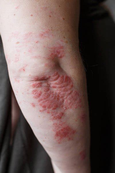 Psoriasis On Elbow Closeup Photo Of Dry Flaky Skin With Red Spots
