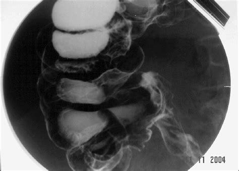 Double Contrast Barium Enema Showing Outlines Of The Inverted Appendix