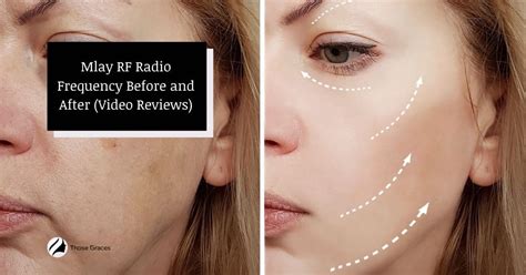 Mlay Rf Radio Frequency Before And After Treatment Videos