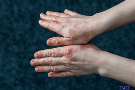 Dyshidrotic Eczema Affect Nails Bios Pics