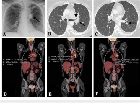 Imaging Demonstrates A Metastatic Lung Cancer A Chest X Ray Shows A