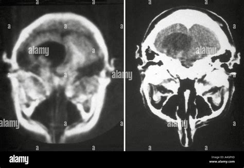 Ct Scan Left And An Nmr Scan Right Of A Cerebral Astrocytoma