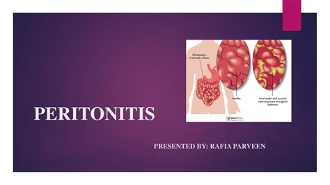 Solution Peritonitis Ppt Studypool