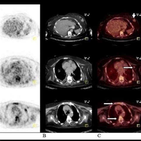 Axillary Lymph Node Metastasis In A 51 Year Old Woman With A 25 Cm