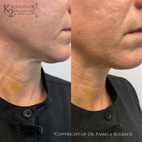 Browse Our Before And After Gallery Dr Pamela Kulback
