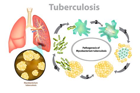 Progression De La Tuberculose Pulmonaire Vecteurs Libres De Droits Et