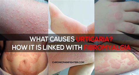 Urticaria Also Know As Hives Is A Skin Condition Which After Itching