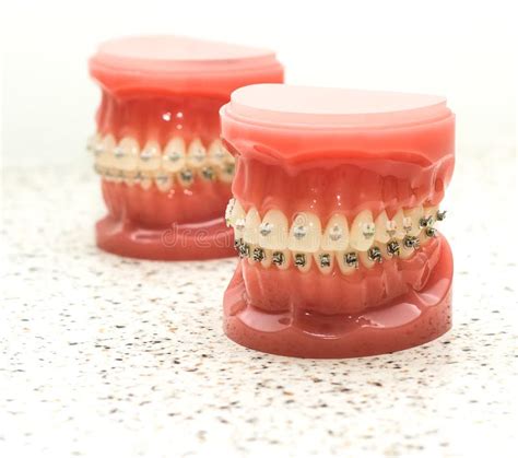 Dentist Demonstration Teeth Model Of Orthodontic Bracket Stock Image Image Of Close Color