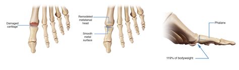 Understanding Hallux Rigiduslimitus A Proven Toe Implant Solution